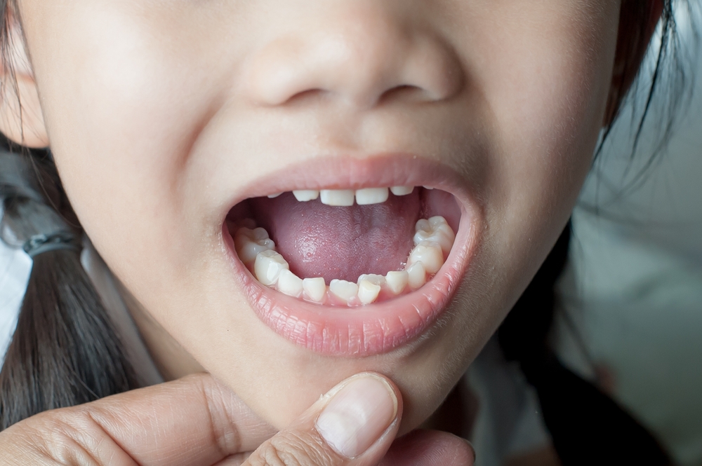 What is Malocclusion? Understanding the Basics of Misaligned Teeth
