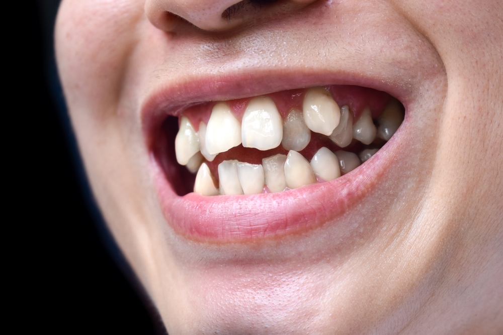 Can Misaligned Teeth Be Corrected?